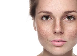 Laser Cutera Excel V – skuteczne leczenie cery naczynkowej